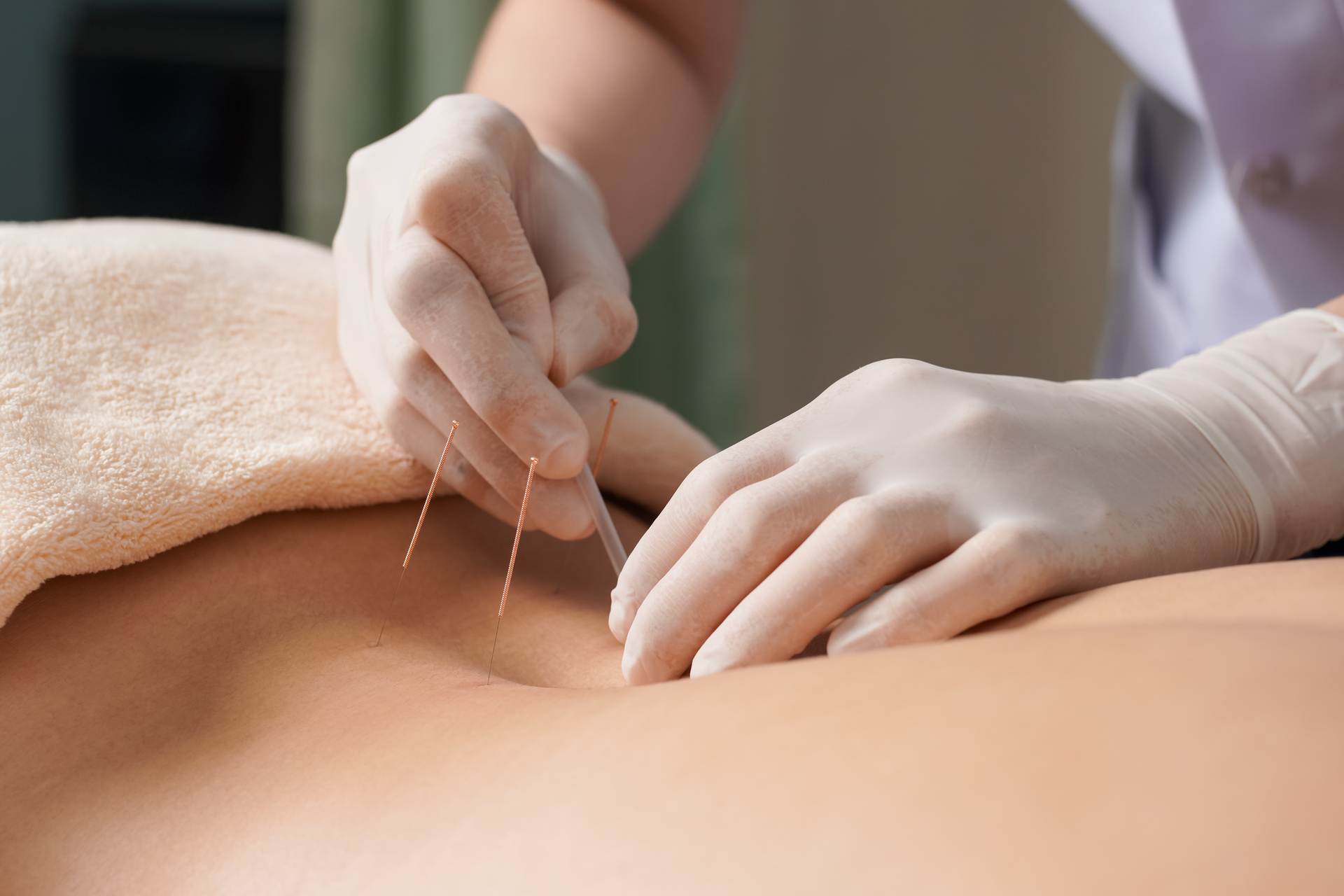 What is Acupuncture and What Can it Do for Me?