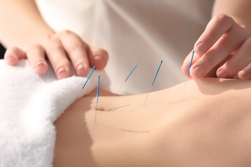 Young,Woman,Undergoing,Acupuncture,Treatment,,Closeup