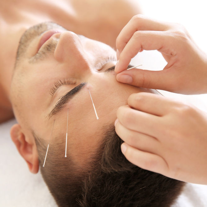 Young,Man,Undergoing,Acupuncture,Treatment,In,Salon,,Closeup