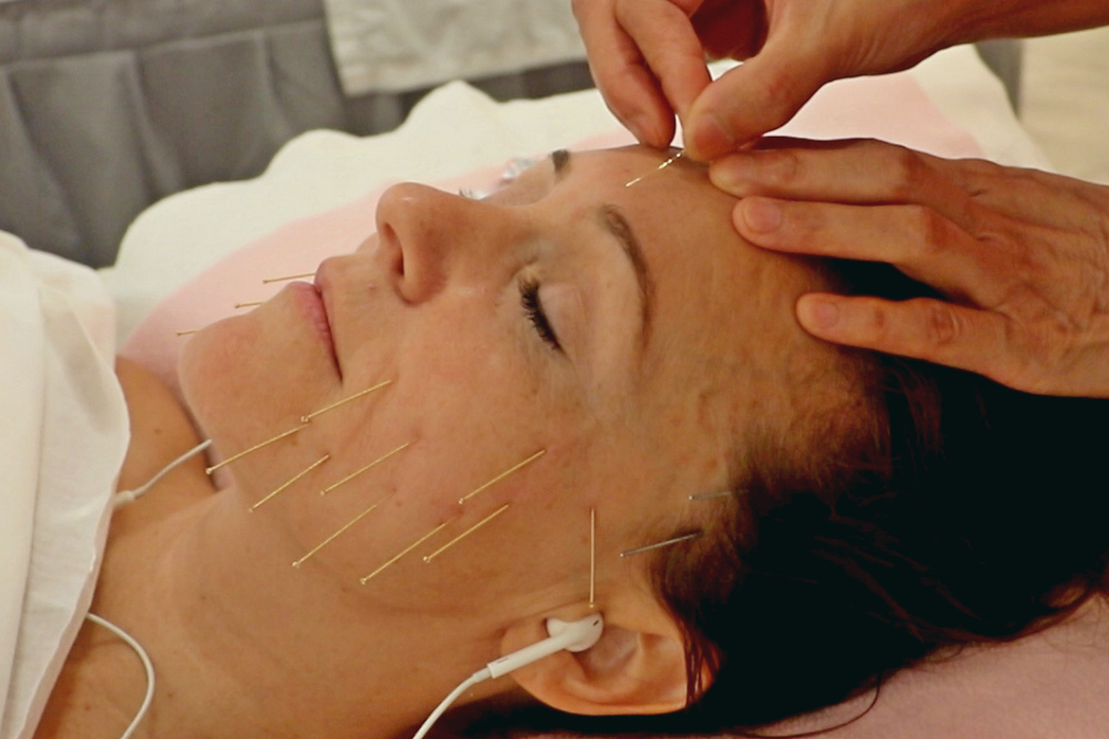 golden needle facials acupuncture