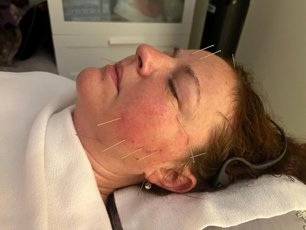 Top Three Benefits of Facial Acupuncture