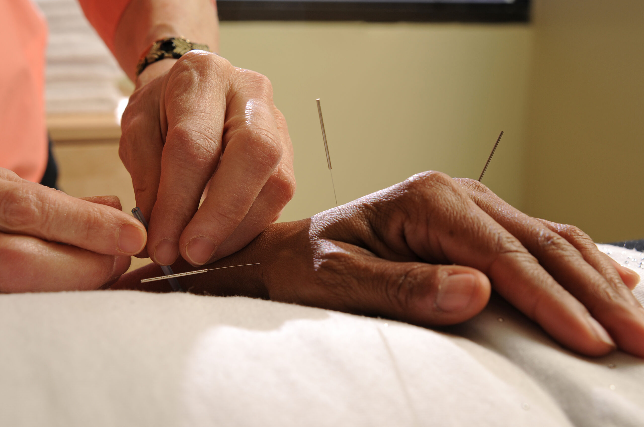 Acupuncture,Treatment