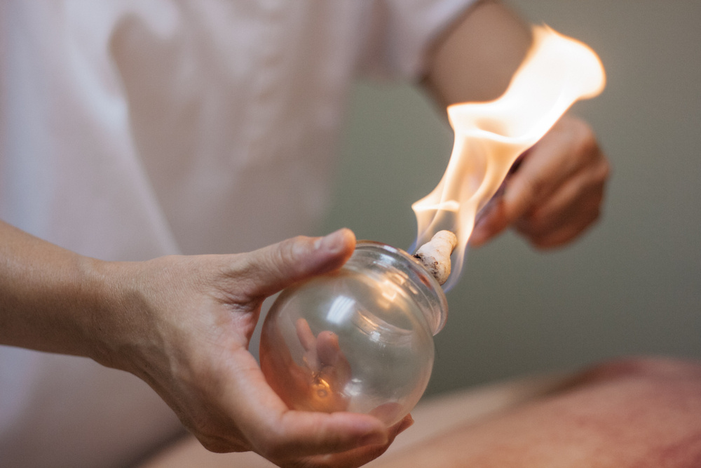 The Benefits of Cupping Therapy