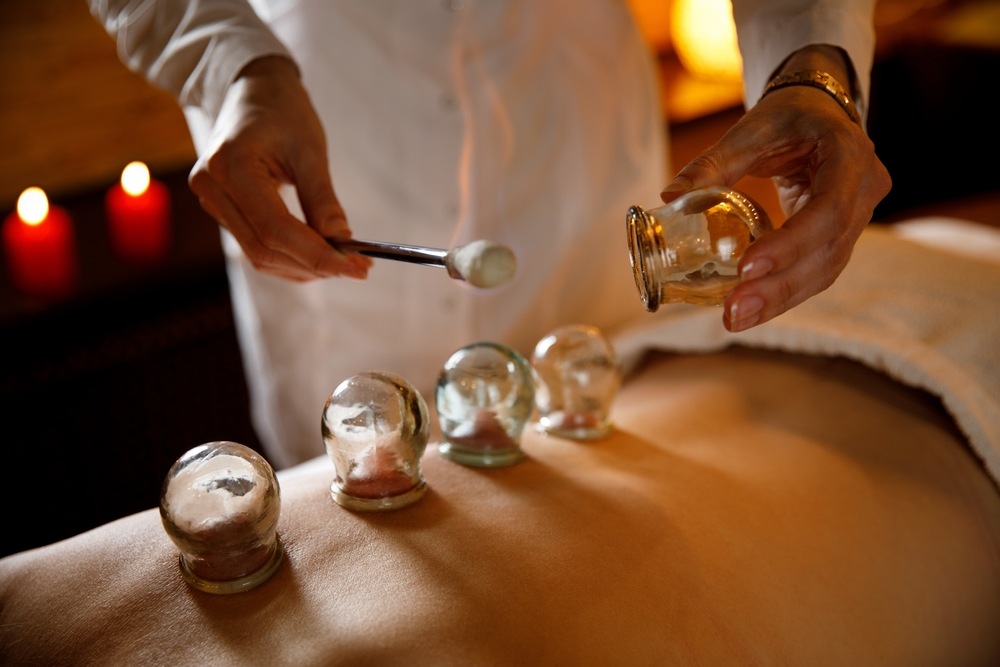 Benefits of Combining Cupping Therapy With Acupuncture for Pain Relief