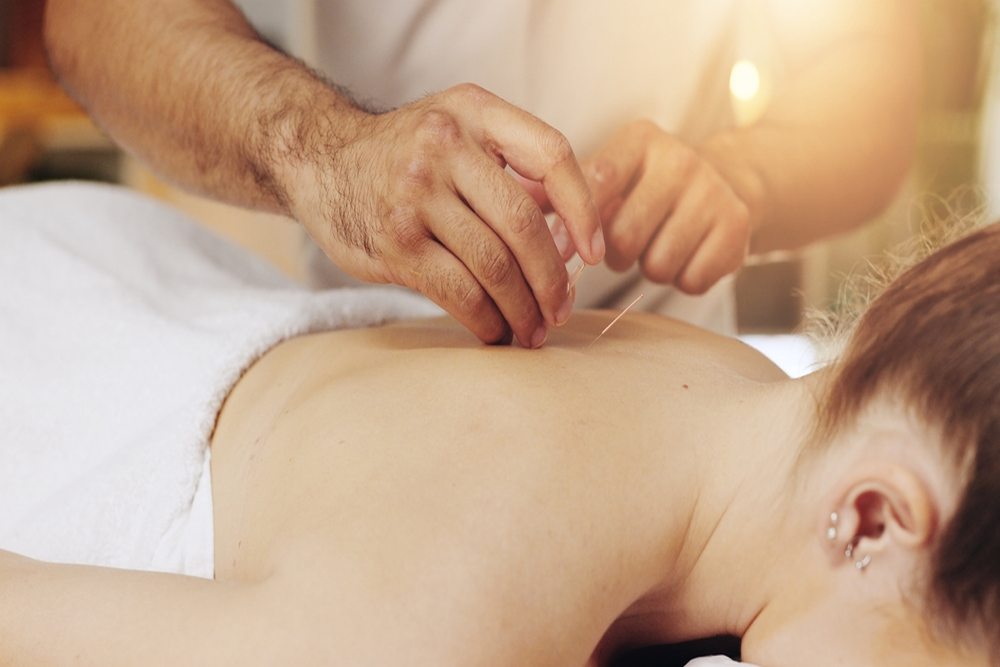 How Acupuncture Can Support Relaxation and Stress Relief