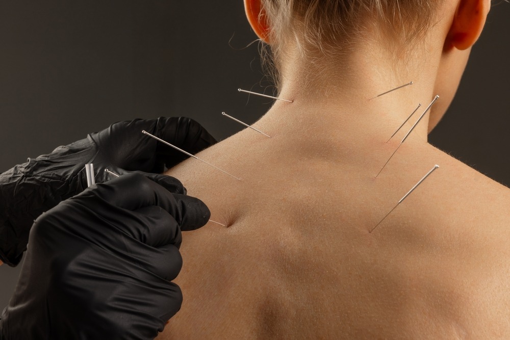 How Acupuncture May Help Relieve Muscle Tension and Everyday Aches